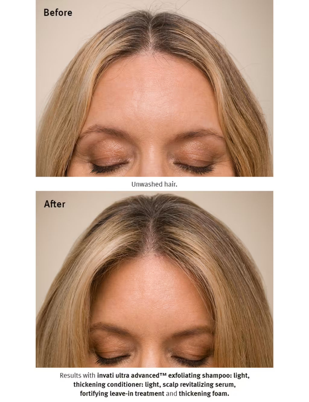 Hair density improvement after 12 weeks with Invati serum